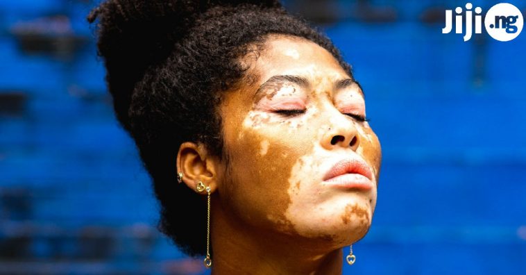 Causes And Symptoms Of Vitiligo